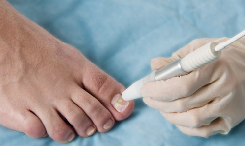 Nagelpilz-Entfernung mit dem Laser, Laserzentrum Kempen